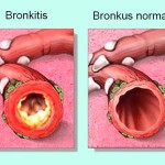 Obat Herbal Bronkitis